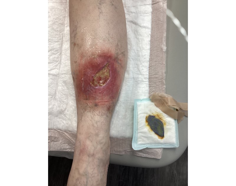 VL-wound-2.13.23-1