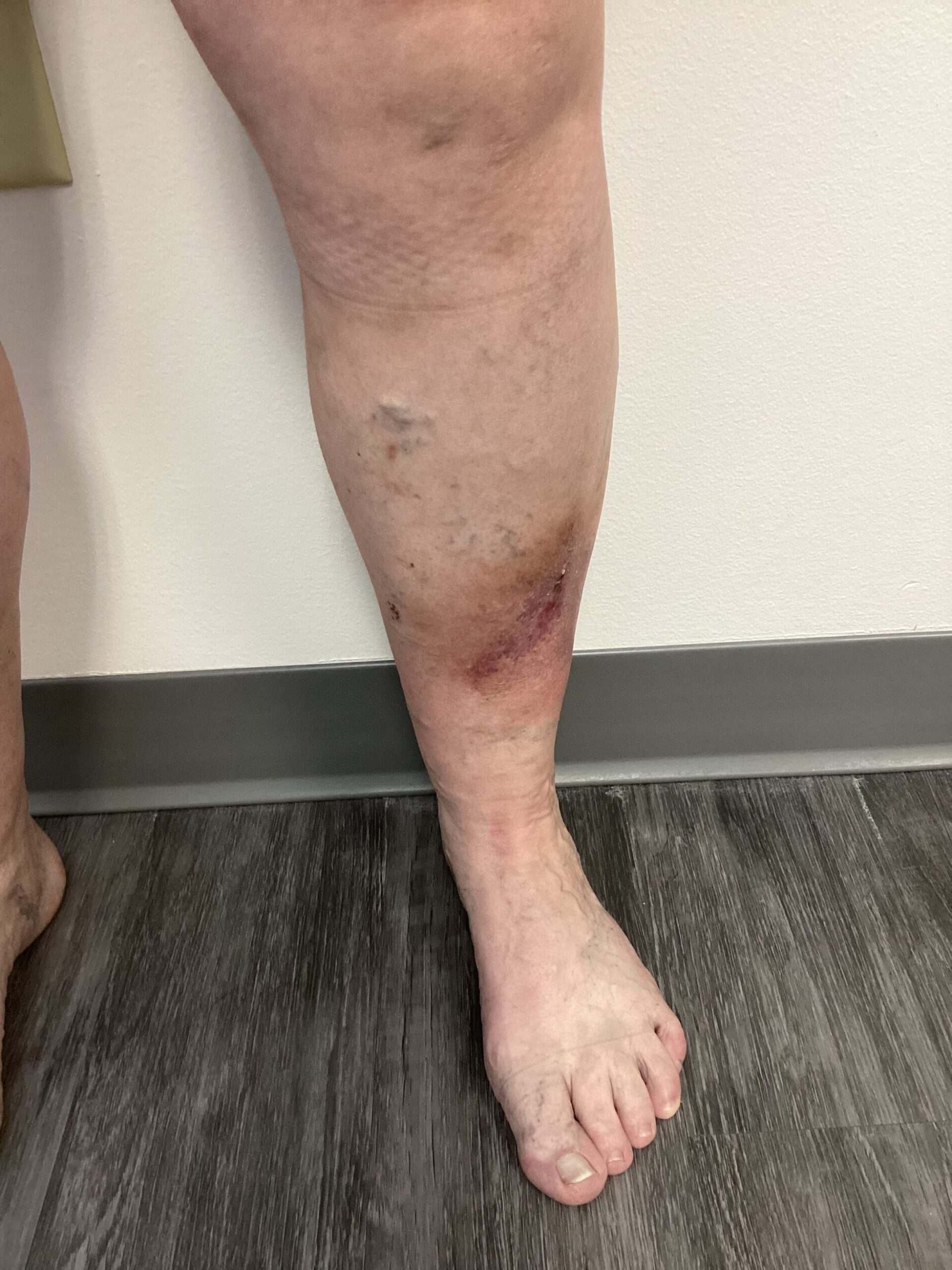 left-anterior-calf-scaled