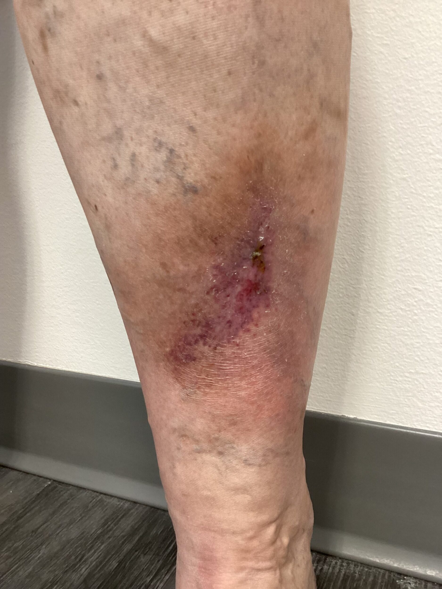 wound-left-anterior-shin-scaled
