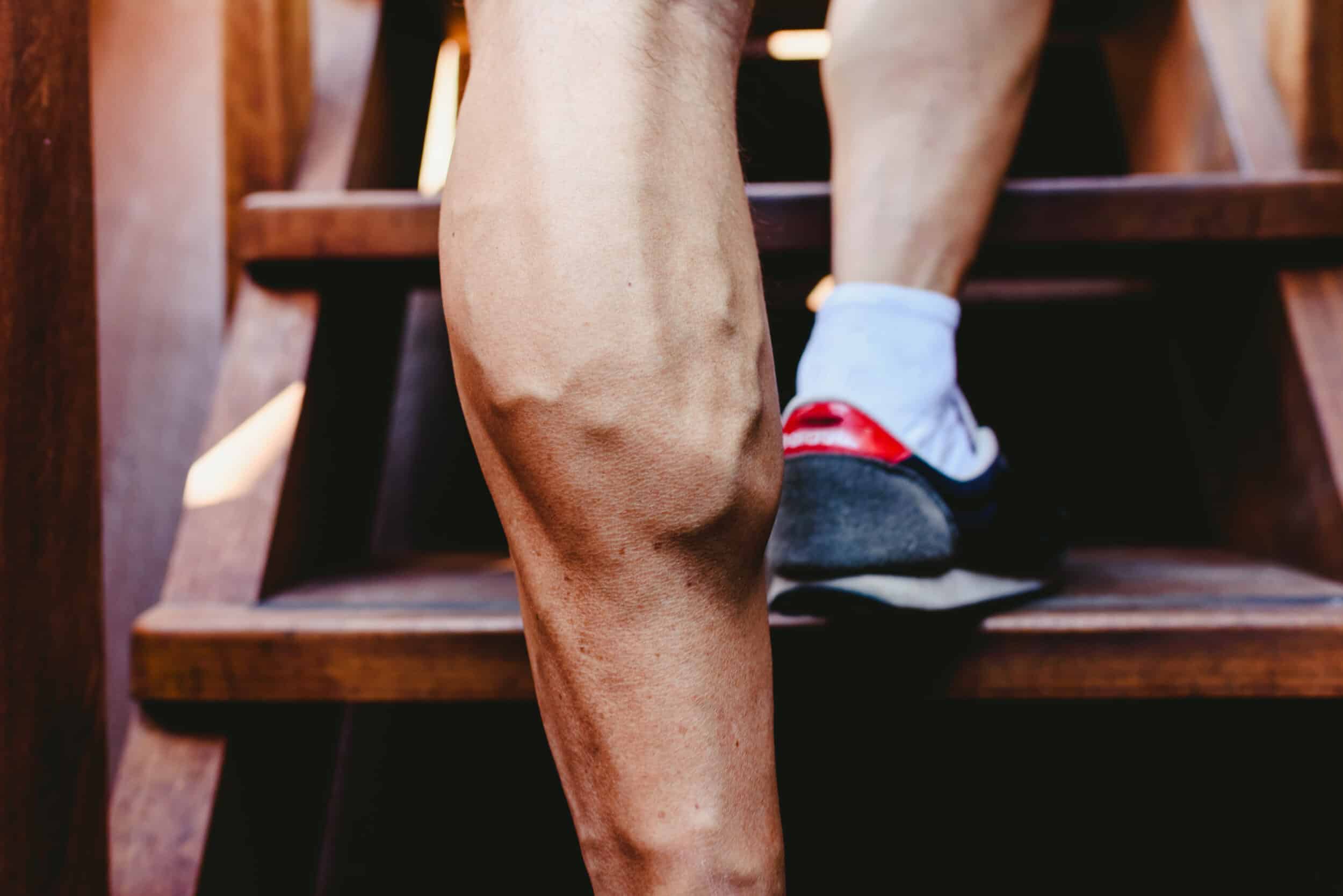 Man with bulging veins on legs walking up stairs in Minneapolis, MN